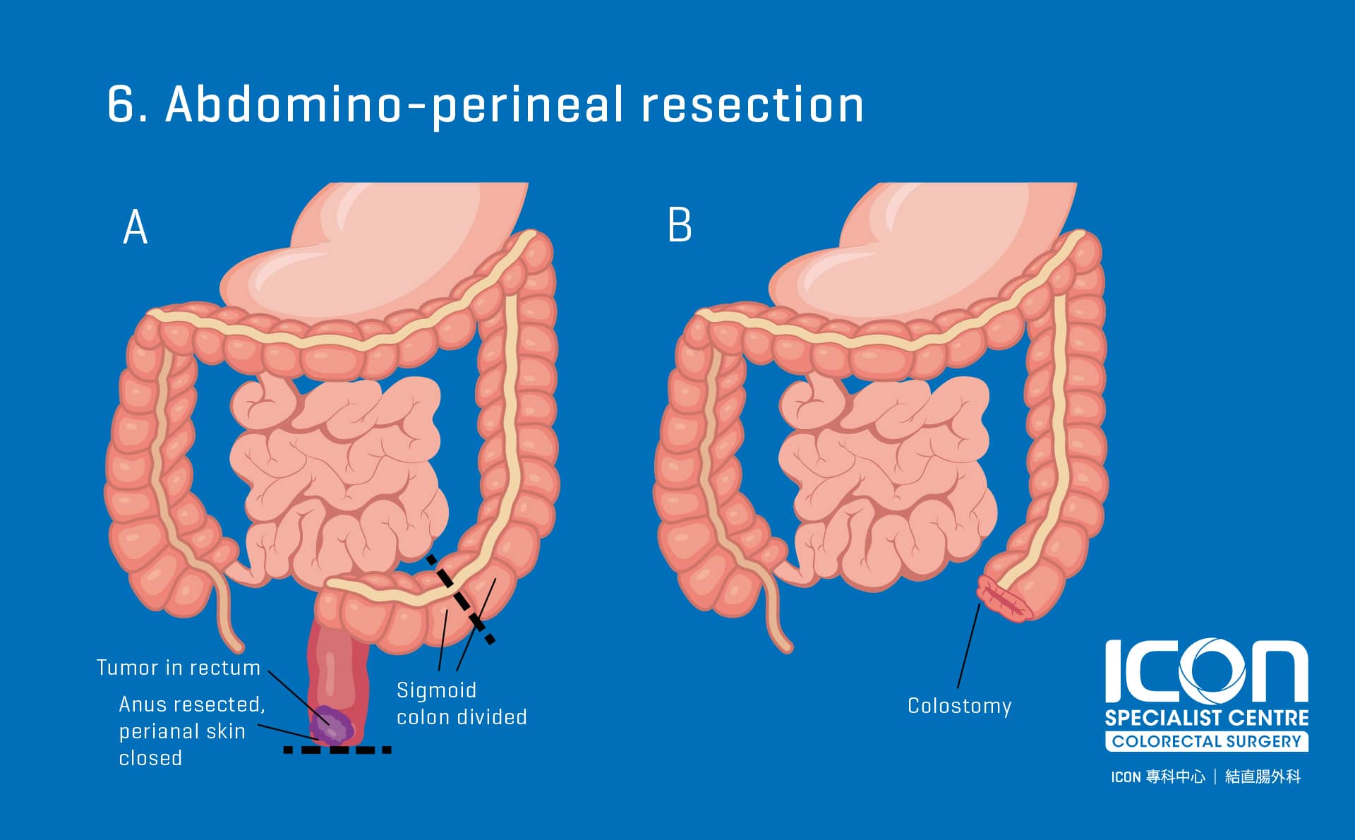Colorectal Resection Colectomy — Icon Specialist Centre 8867