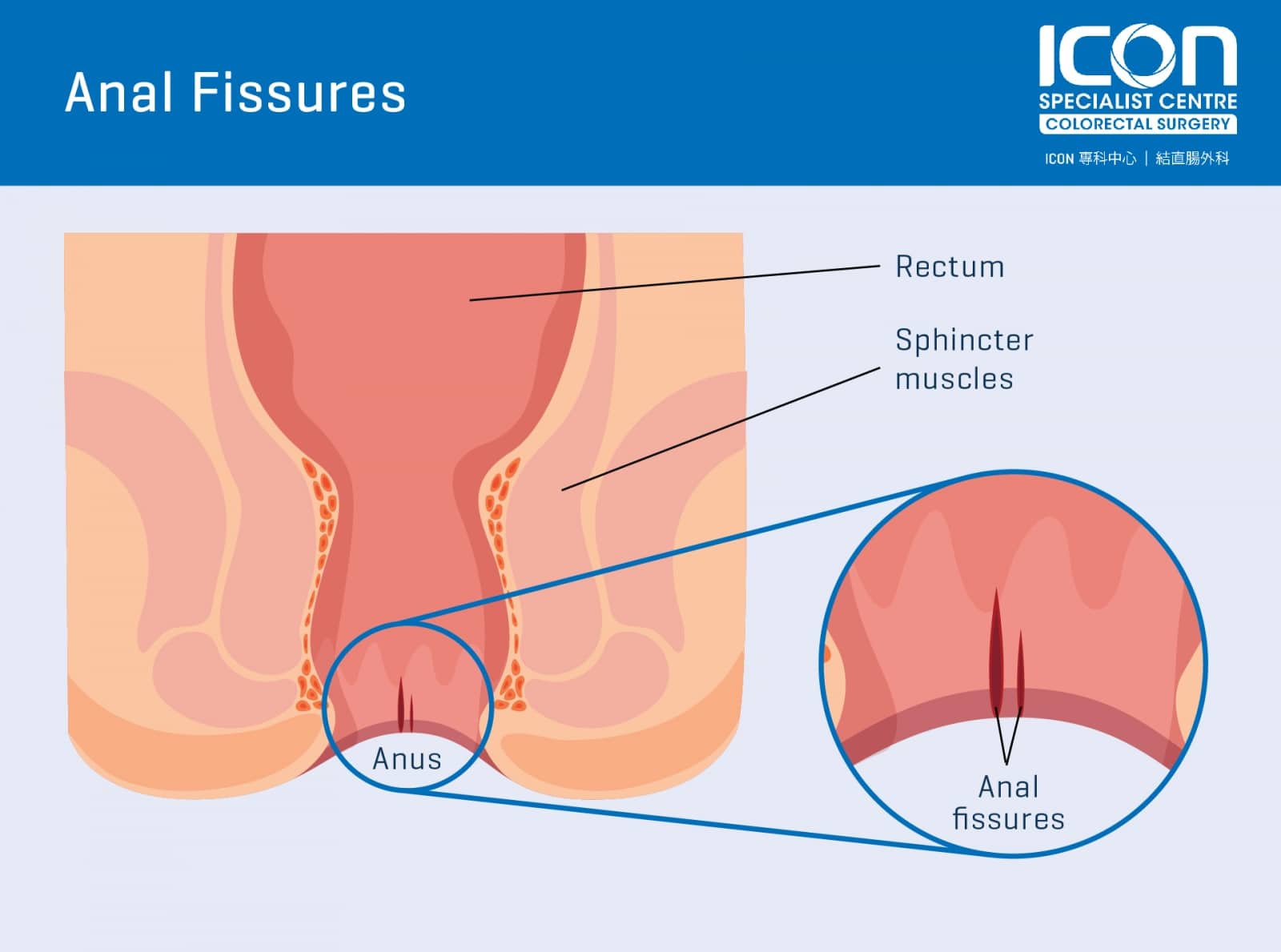 Fissure anal Anal fissure,