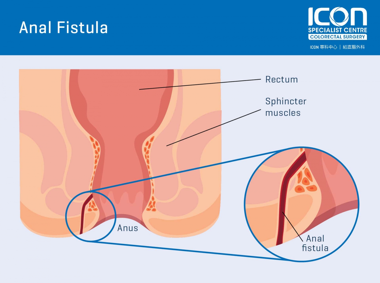 anal fistula surgery