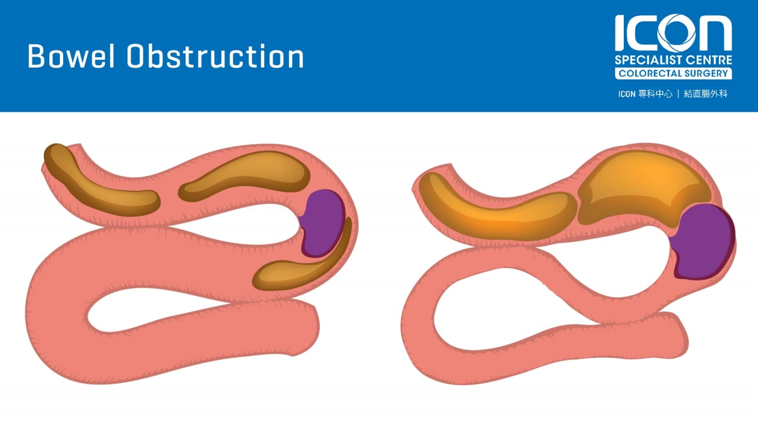 Bowel Obstruction — Icon Specialist Centre 