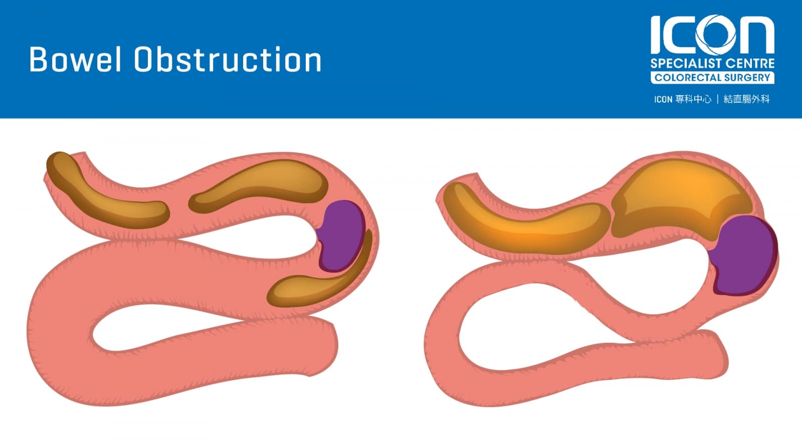 Bowel Obstruction 1600x888 