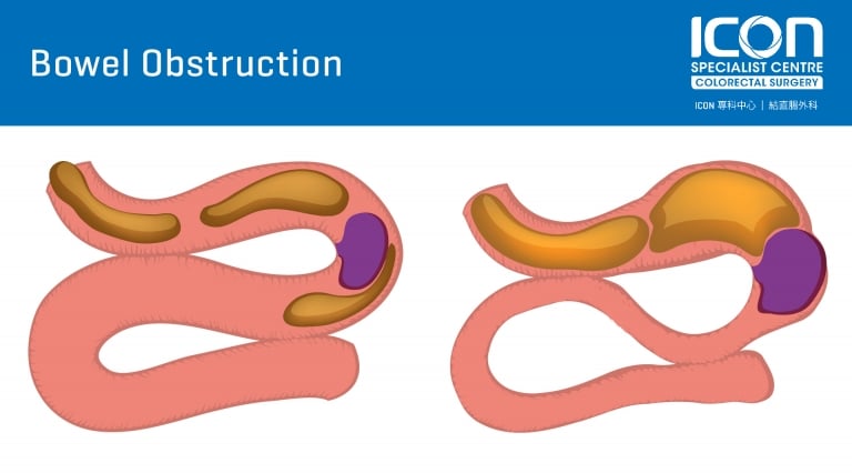 bowel-obstruction-icon-specialist-centre