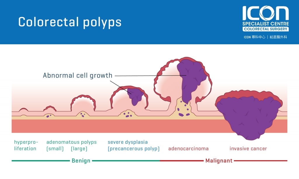 colorectal-polyps-icon-specialist-centre