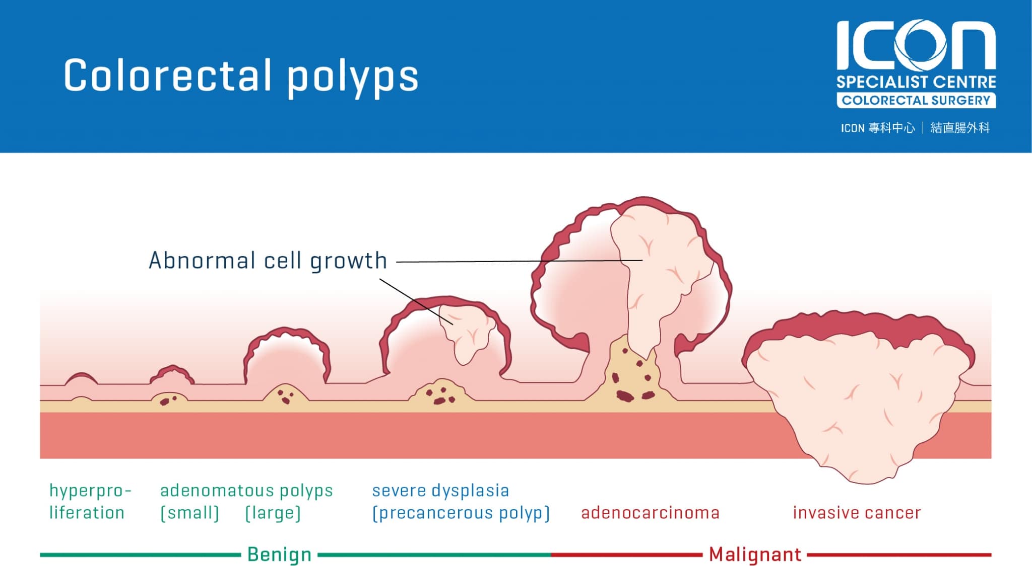 colorectal-polyps-icon-specialist-centre