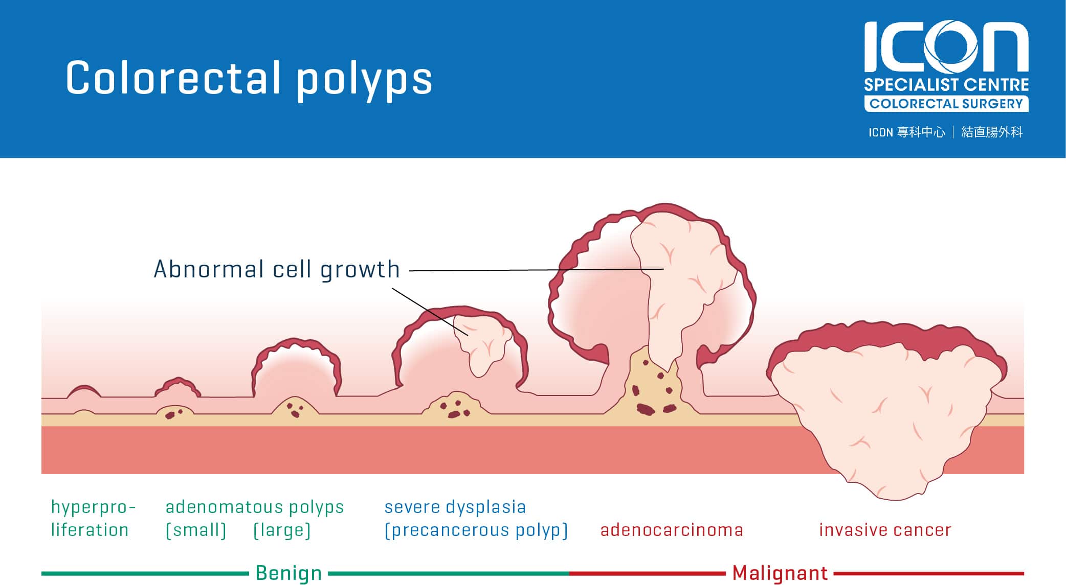 Colorectal polyps — Icon Specialist Centre