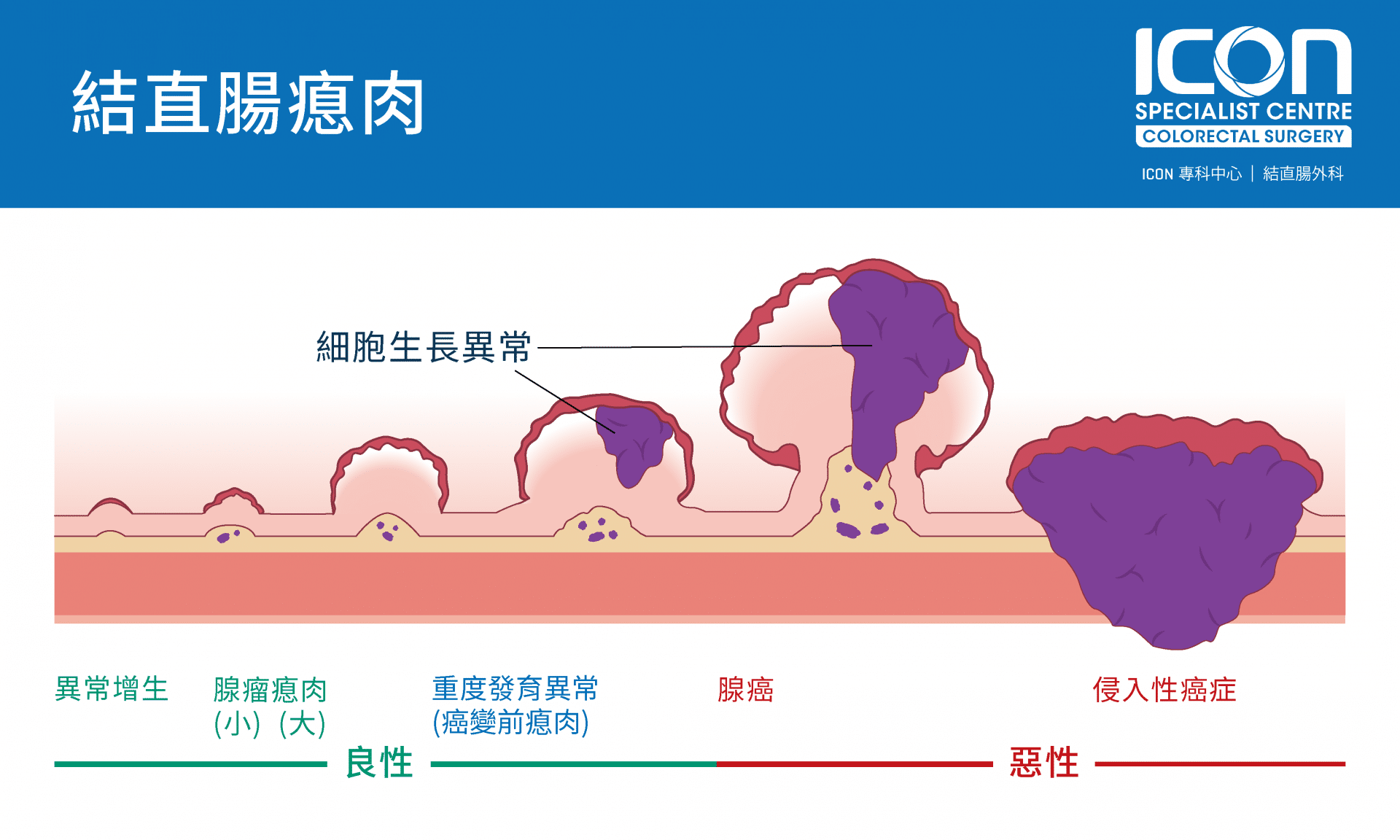 結直腸瘜肉 — ICON專科中心