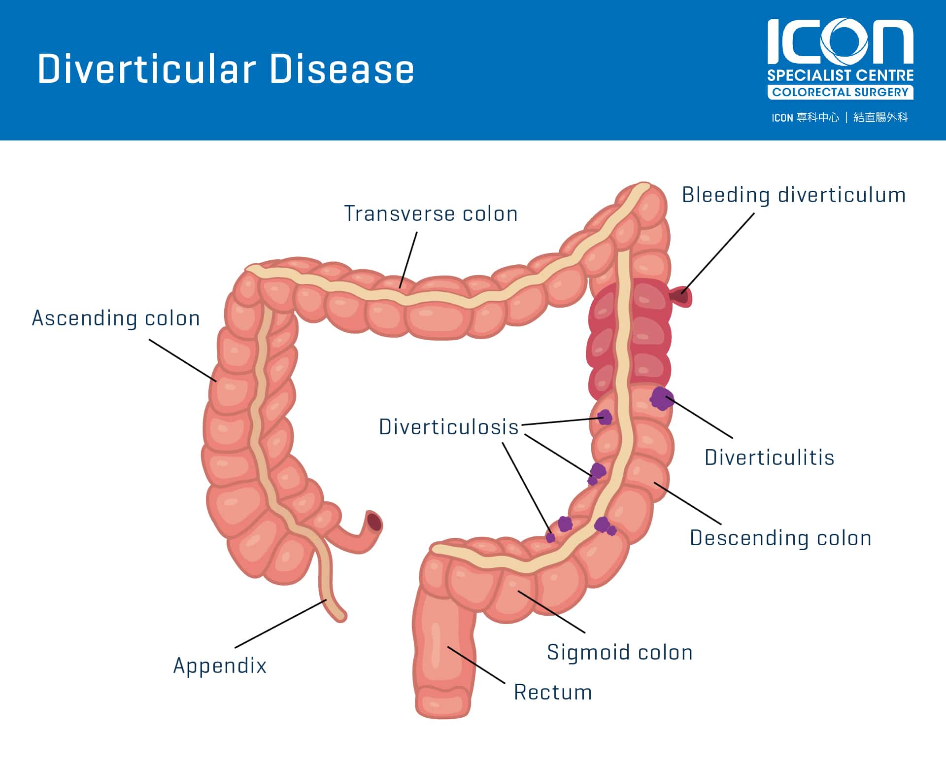 Diverticular Disease — Icon Specialist Centre 5553