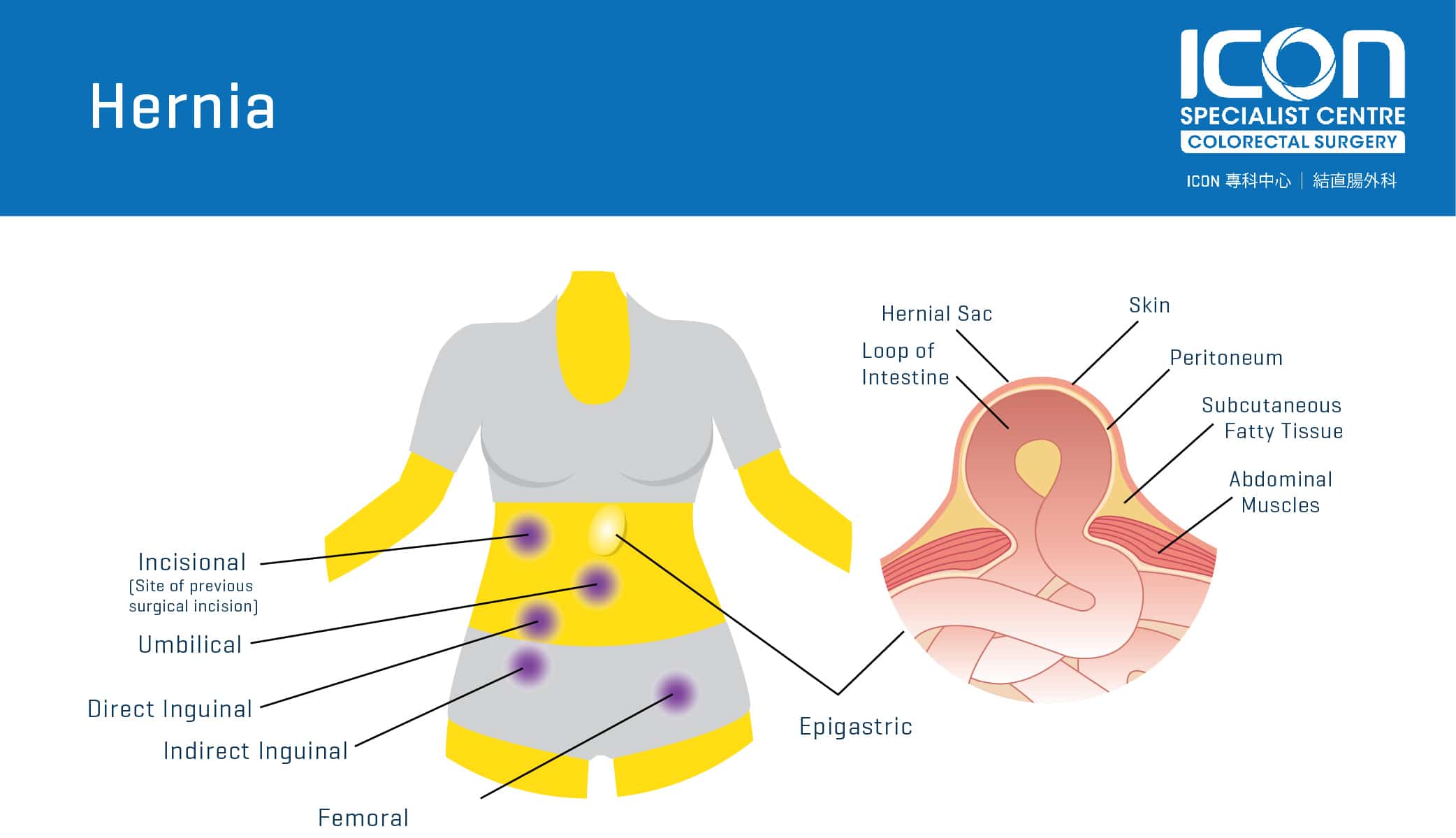 Can A Hernia Cause Bowel Issues