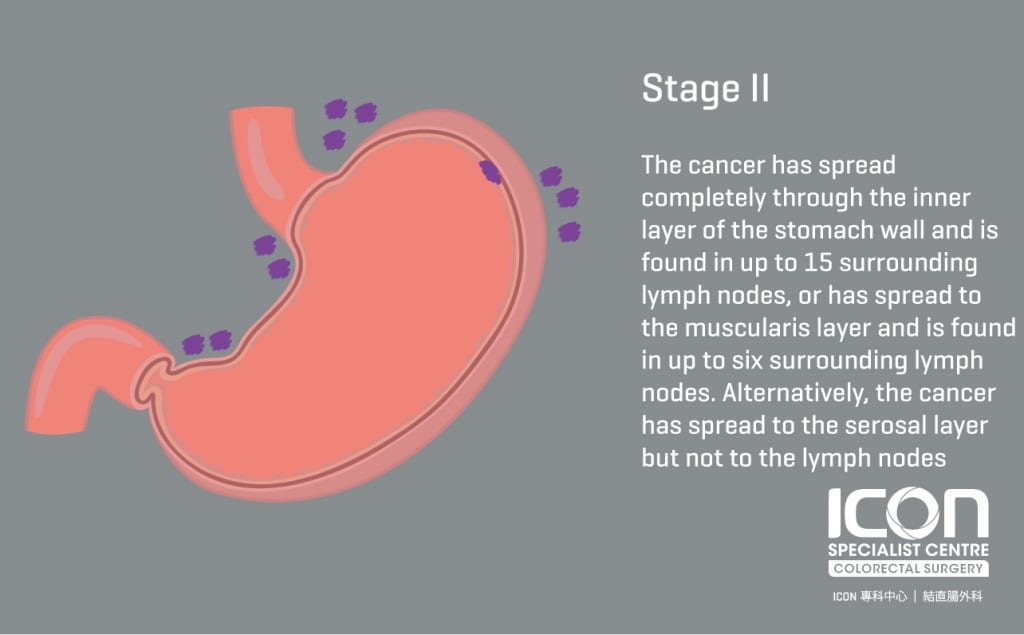 ISC Stages Of Stomach Cancer Stage II 1024x635 