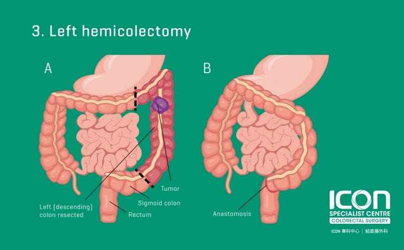 Colorectal Resection Colectomy — Icon Specialist Centre 9165