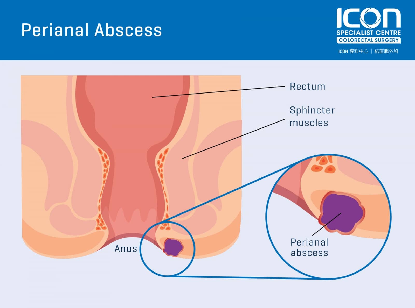 With perianal fistulas