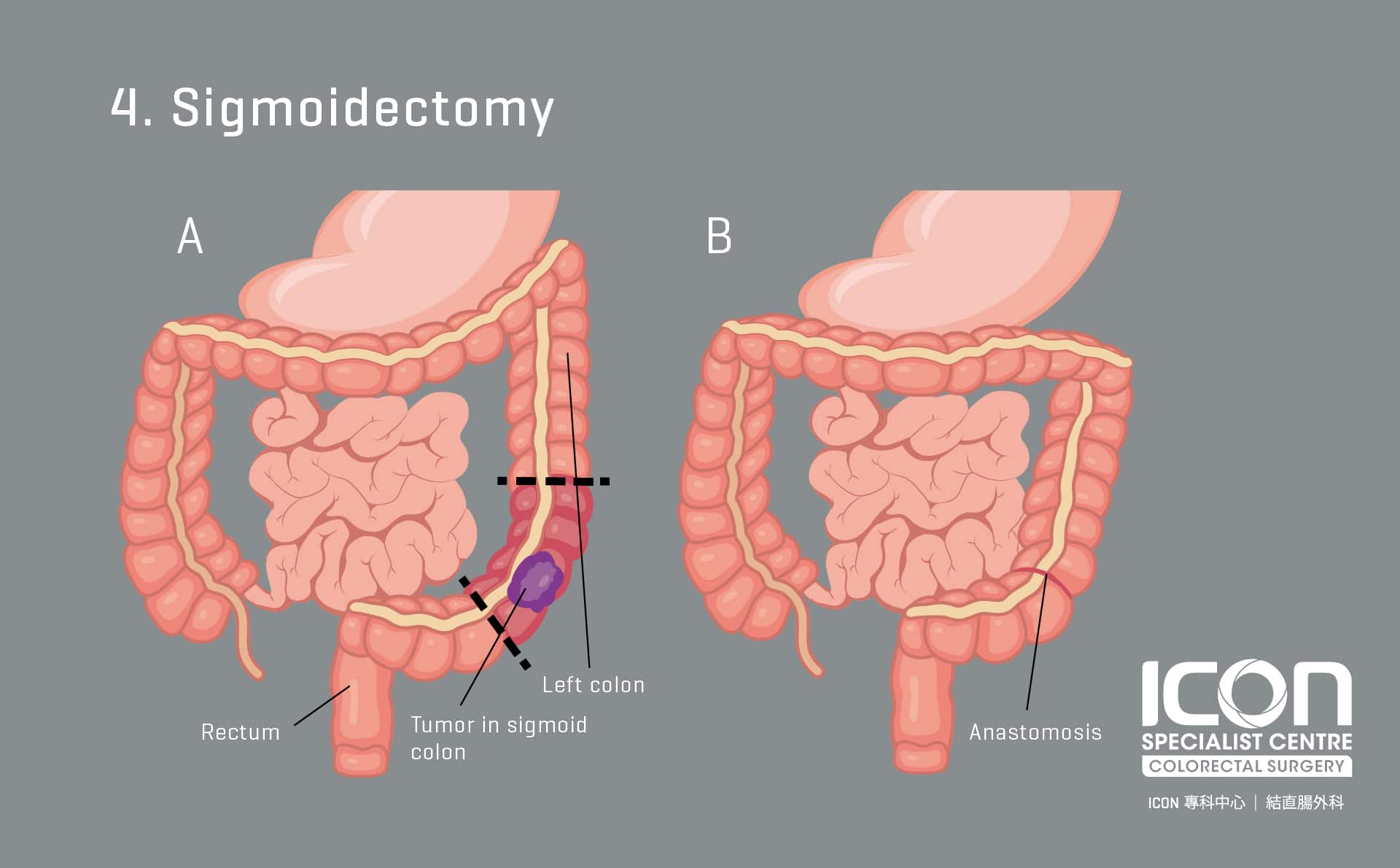 colorectal-resection-colectomy-icon-specialist-centre