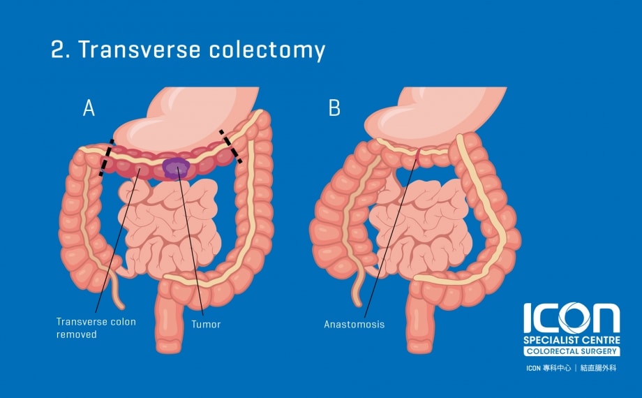 Colorectal Resection Colectomy Icon Specialist Centre