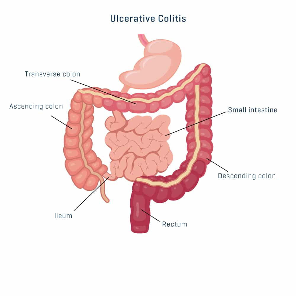 Colitis Icon Specialist Centre