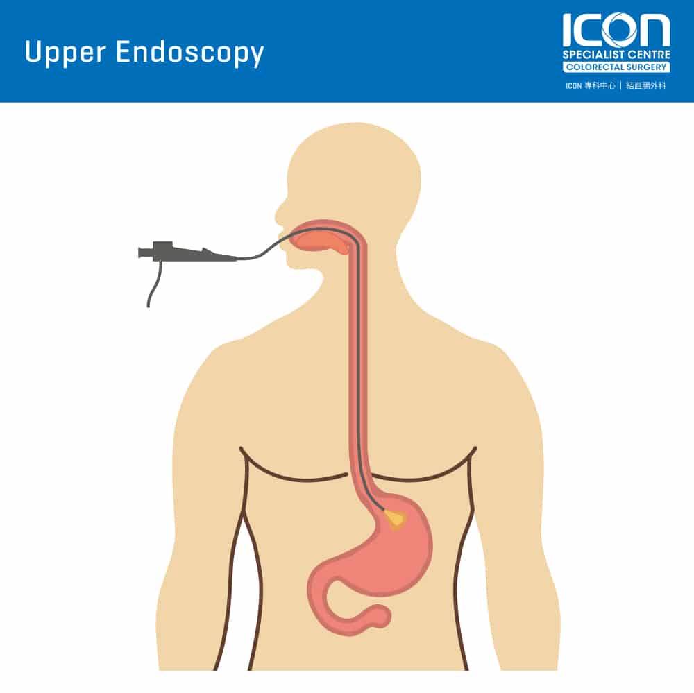 after effects of upper endoscopy